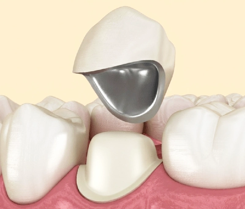 Lớp sườn kim loại là tác nhân gây hại khi bọc răng sứ kim loại lâu dài